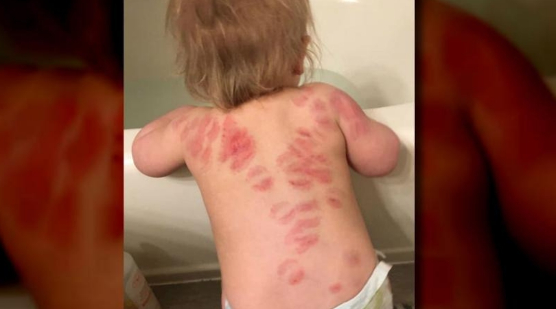 Little Girl Bitten More Than 25 Times While At Daycare; Mom DEMANDS Answers - STAR POLITICAL