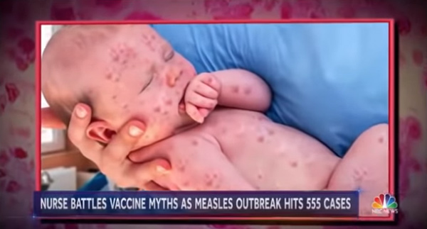 Measle-infected baby photos FAKED by NBC News to push mass hysteria and demand vaccine compliance – NaturalNews.com