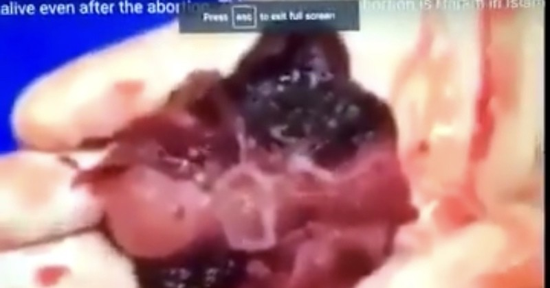 New Video Emerges That Shocks Pro-Choicers Everywhere - Tell Me This IS NOT ALIVE (WARNING GRAPHIC) - NewsBoard.us