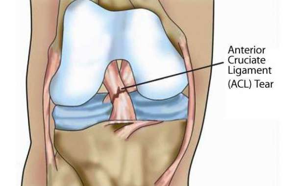 ACL Reconstruction for Knee Ligament