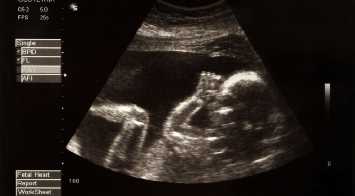 Idaho Senate Committee Passes Bill Banning Abortions When Unborn Baby’s Heart Starts Beating  |  LifeNews.com