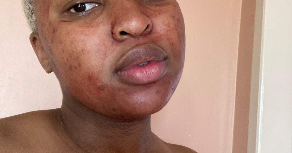 Welcome to Elizabeth's Blog?: Lady shares her experience after she used her period blood on her face to get a Glowing skin