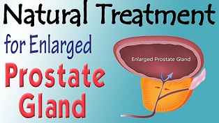 When does prostate enlargement begin and how can it be cured? – Secrets of HIV-Aids Journal