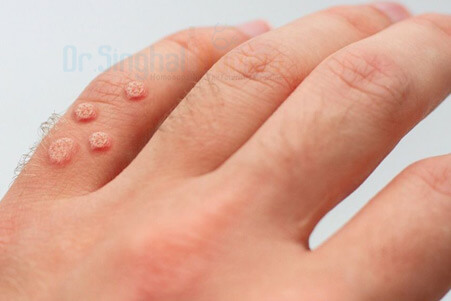 Homeopathic Treatment for Warts | Warts Homeopathy Medicine