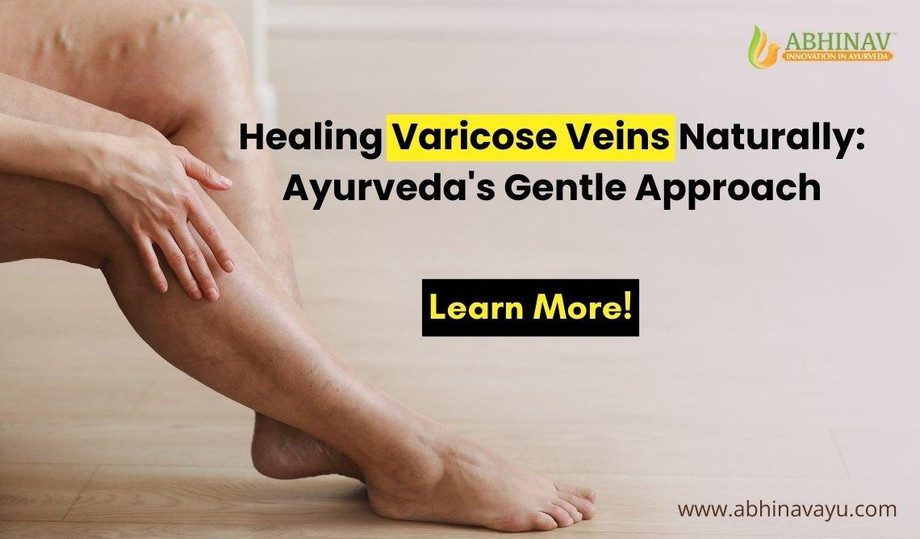 Healing Varicose Veins Naturally: Ayurveda's Gentle Approach - JustPaste.it