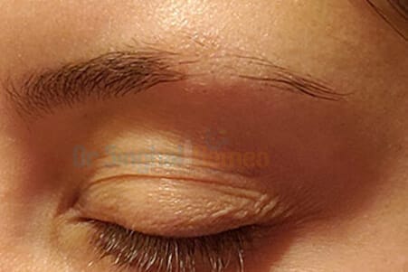 Homeopathic Medicine for Eyebrow Hair Loss: Safe & Effective